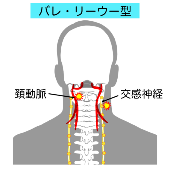 頸椎捻挫型